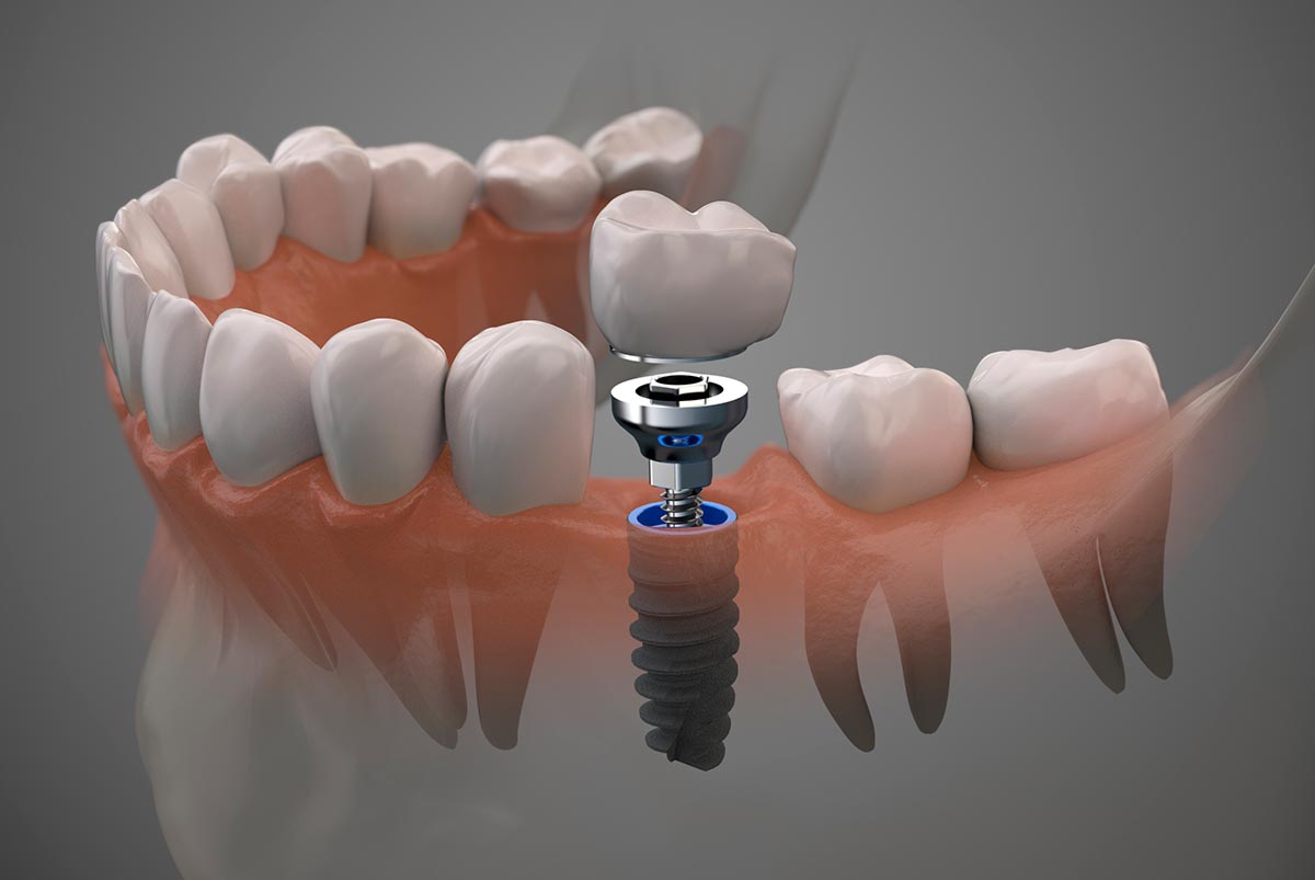 Implante Dental