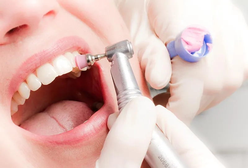 Limpieza dental