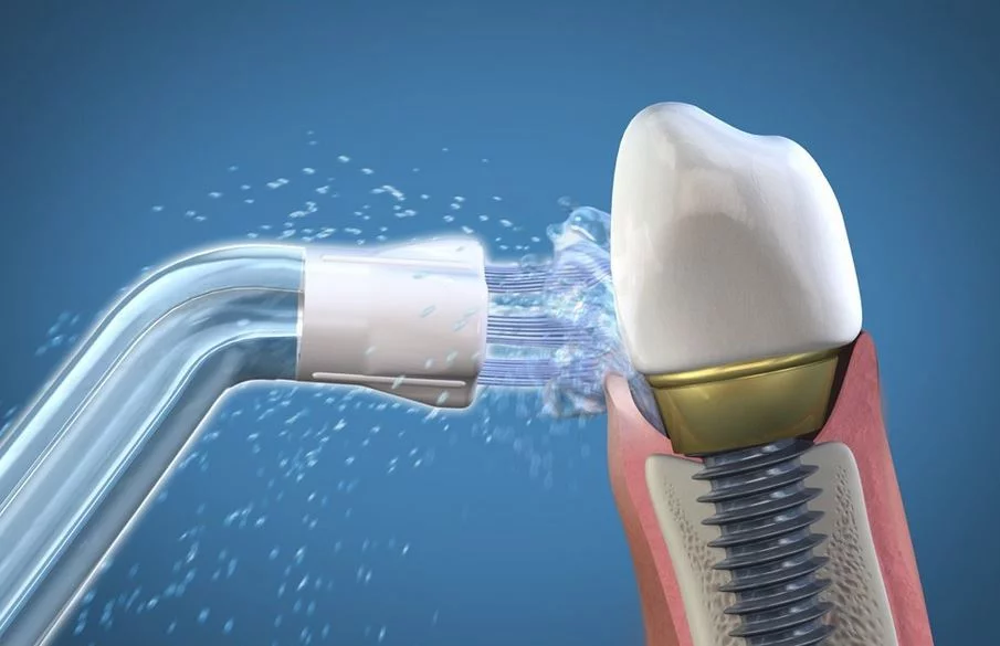 Limpieza de los Implantes dentales