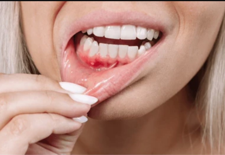 Periodontitis